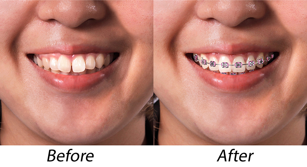 Briter Dental | Orthodontics, Implant Supported Dentures and Dental Fillings