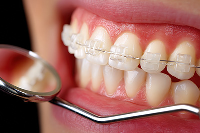 Briter Dental | Geriatric Dentistry, Invisalign reg  and Night Guards