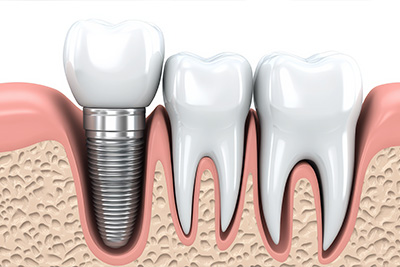 Briter Dental | Dental Sealants, Dental Fillings and Dental Bridges