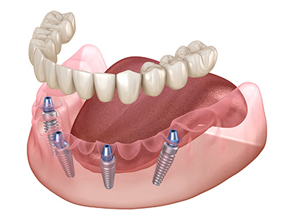 Briter Dental | Pediatric Dentistry, Family Dentistry and Invisalign reg 