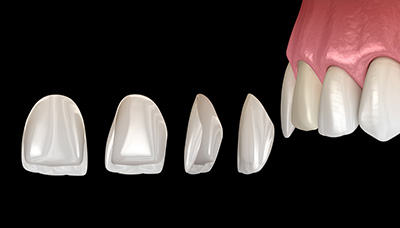 Briter Dental | Teeth Whitening, Dental Bridges and Inlays  amp  Onlays
