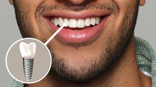 Briter Dental | Implant Dentistry, Implant Restorations and Periodontal Treatment