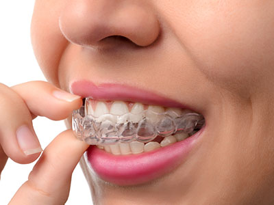 Briter Dental | Invisalign reg , Inlays  amp  Onlays and Dentures