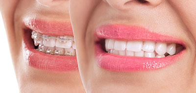 Briter Dental | Orthodontics, Implant Supported Dentures and Dental Fillings