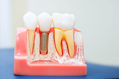Briter Dental | Pediatric Dentistry, Oral Exams and Veneers