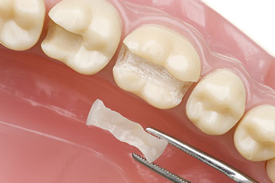 Briter Dental | Family Dentistry, TMJ Disorders and Night Guards