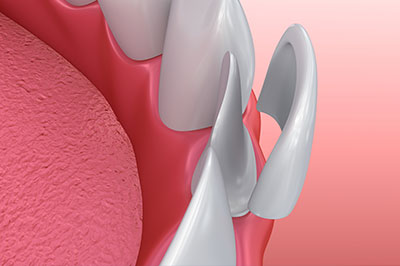 Briter Dental | Teeth Whitening, Dental Bridges and Inlays  amp  Onlays