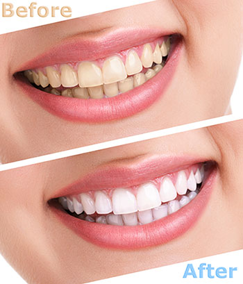 Briter Dental | Orthodontics, Dental Fillings and Bone Grafts
