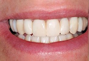 Briter Dental | TMJ Disorders, Cosmetic Dentistry and Veneers