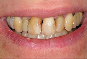 Briter Dental | Cosmetic Dentistry, Pediatric Dentistry and Ceramic Crowns