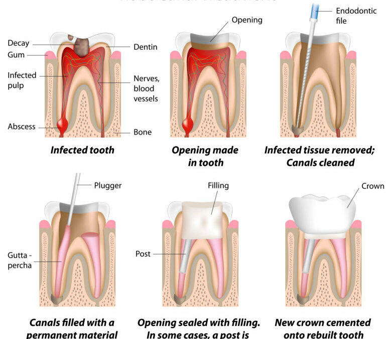 Let’s get past the “Fake News” about Root Canals