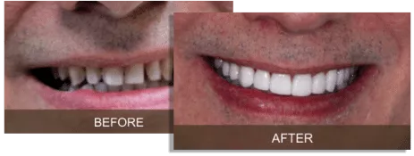 xbefore-after.png.pagespeed.ic.Yk1zGdUigD