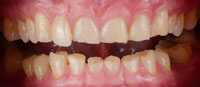Grinding Teeth