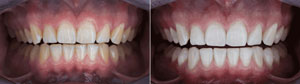 teeth whitening Houston