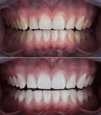 teeth whitening Houston