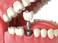 Implant Supported Dentures