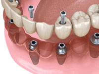 Implant Supported Dentures