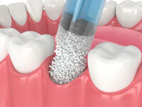 Oral Surgery